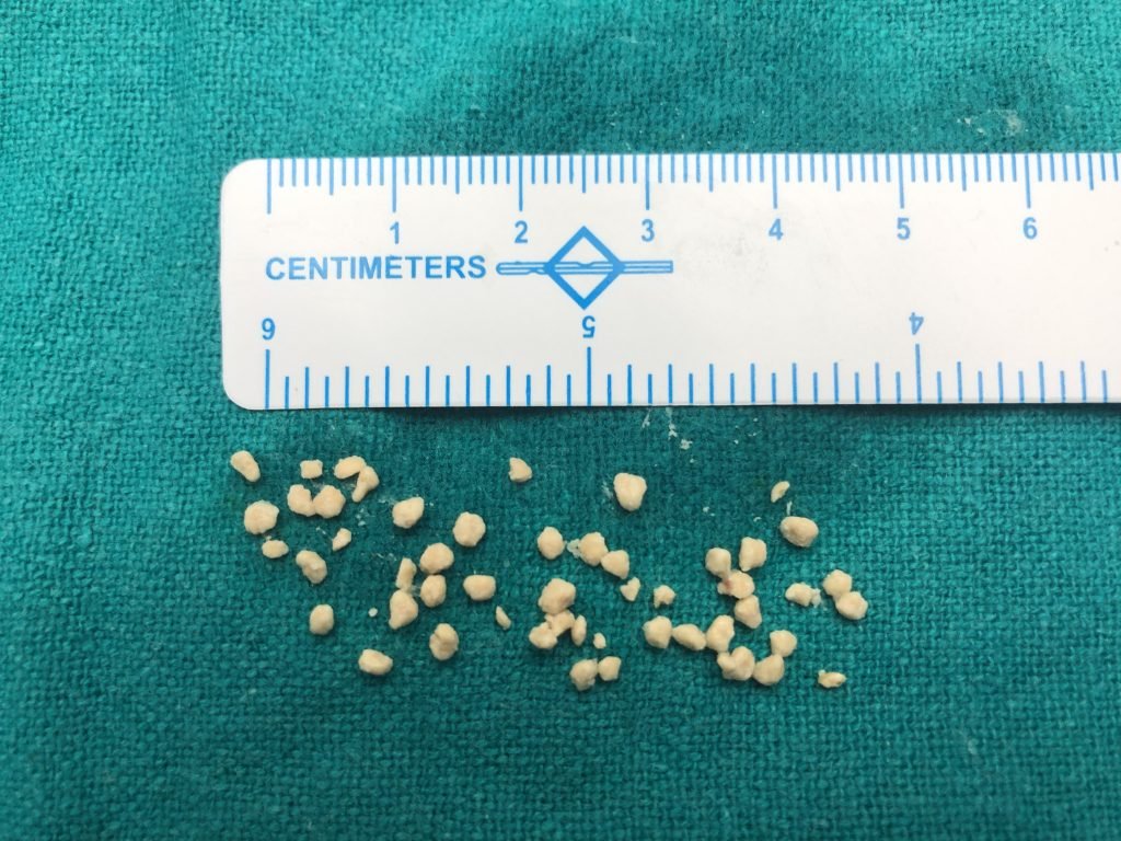 Stone Pics Salivary Gland